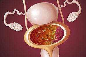 Bakteryjne zapalenie pęcherza moczowego u kobiety